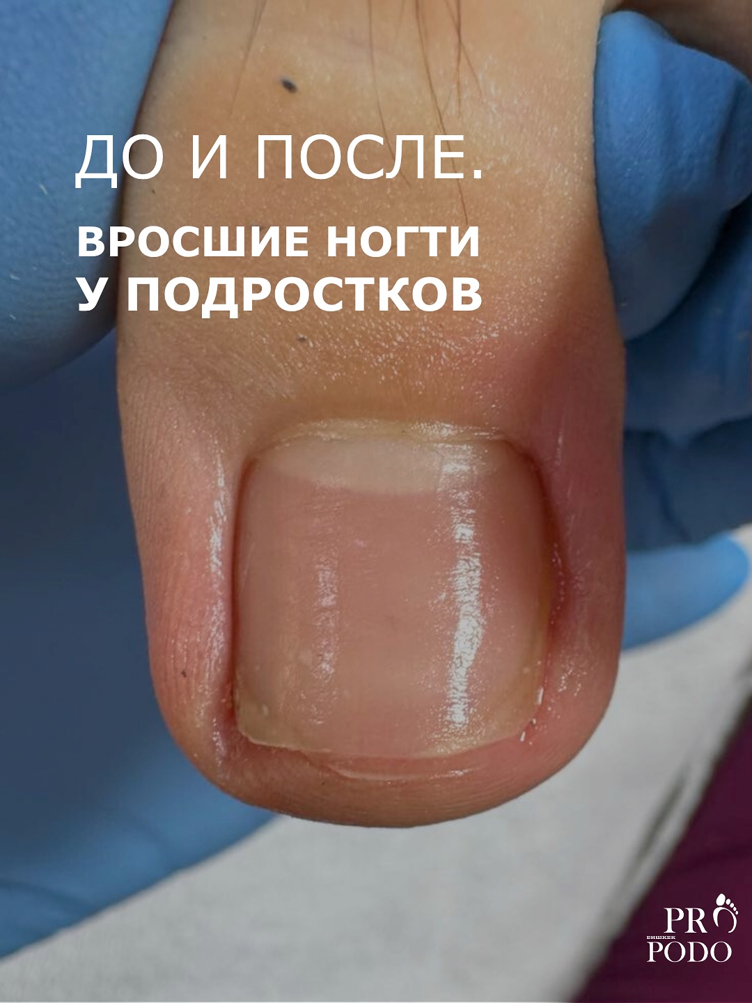 Вросшие ногти у подростков